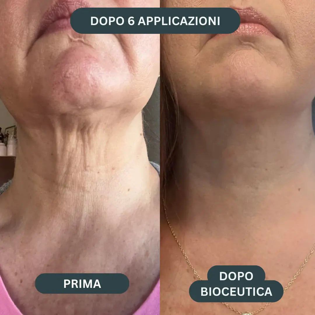 BioInfusion+ | Sistema di Microinfusione